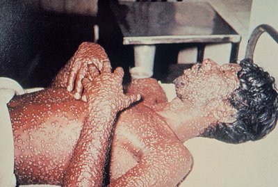 Smallpox - George Shultz, International Terrorist – Part Two